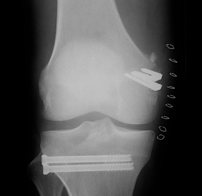 MCL Bony Avulsion ORIF AP